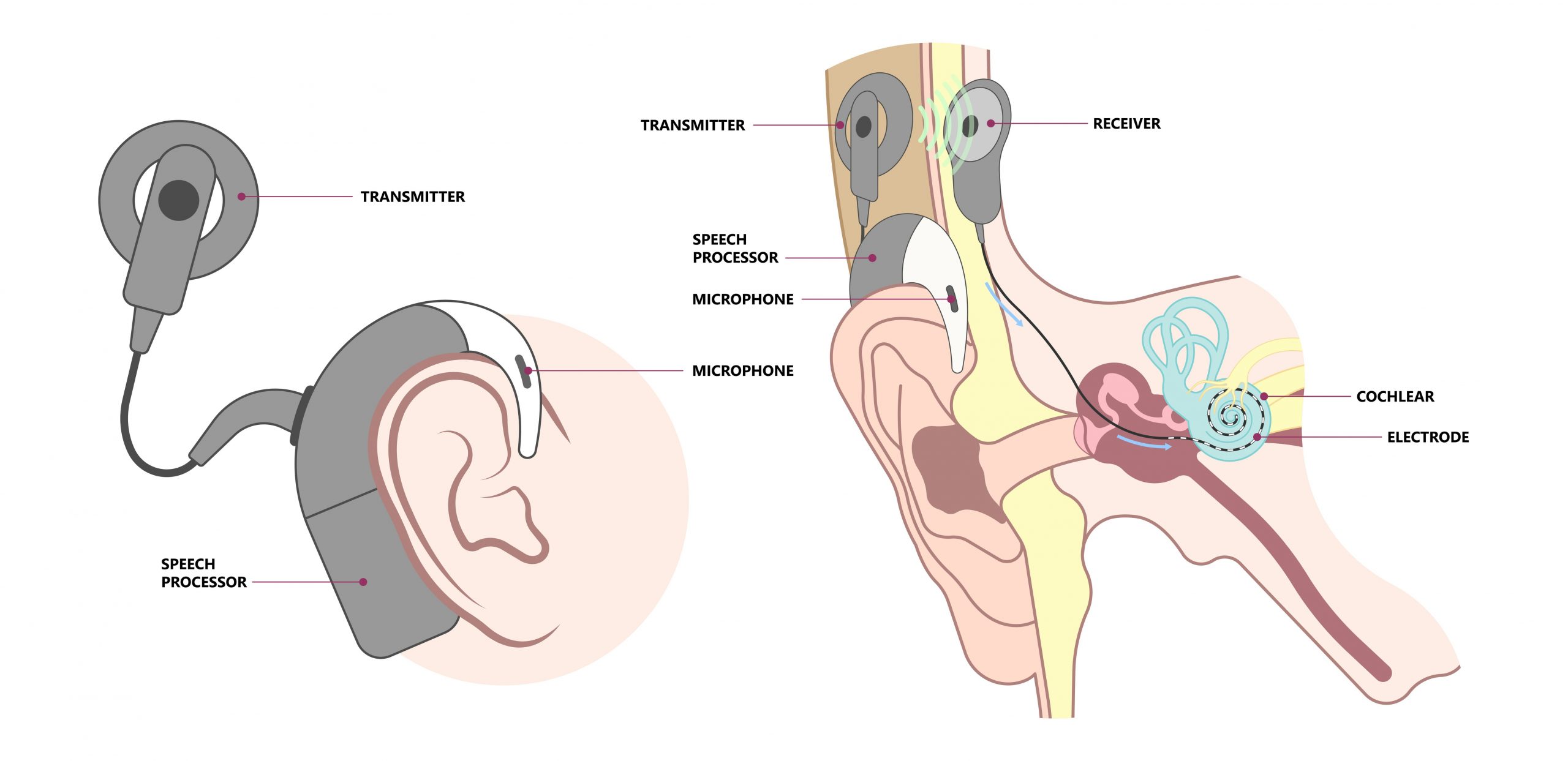 Der Aufbau eines Cochlea-Implantats mit seinen Bestandteilen.
